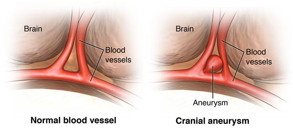 Illustration of cerebral aneurysm